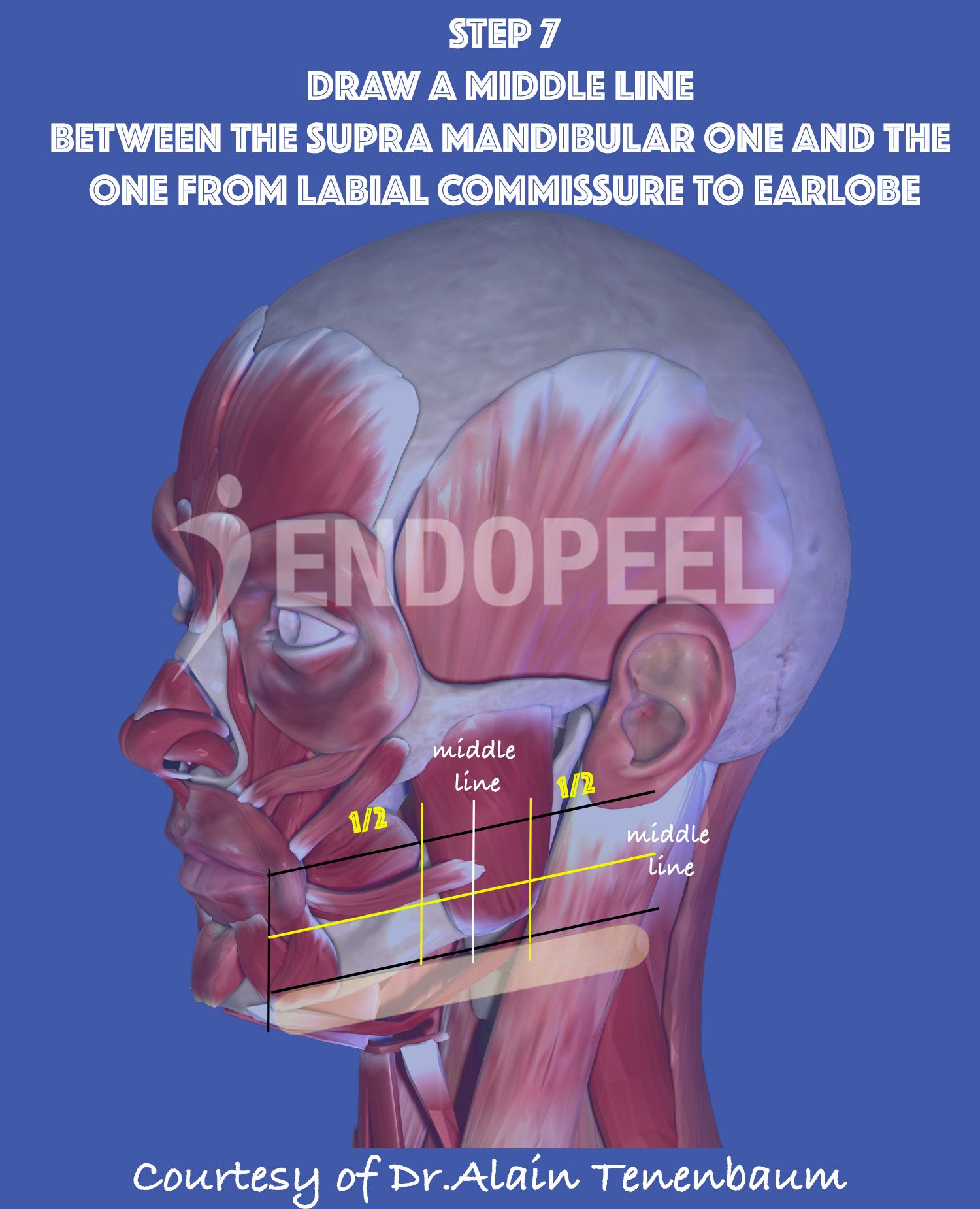 middle line between the supramadibular one and the 1 st line from labial commissure to earlobe