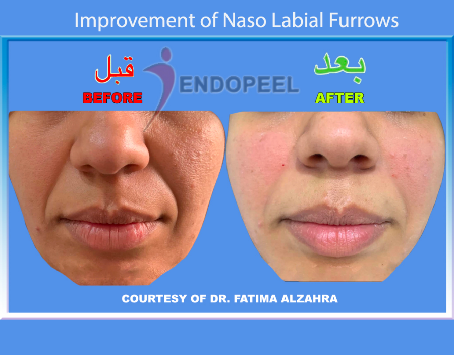 naso labial furrow- Dr Fatima Alzahra