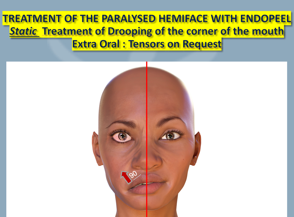 STATIC EXTRA ORAL  TENSORS