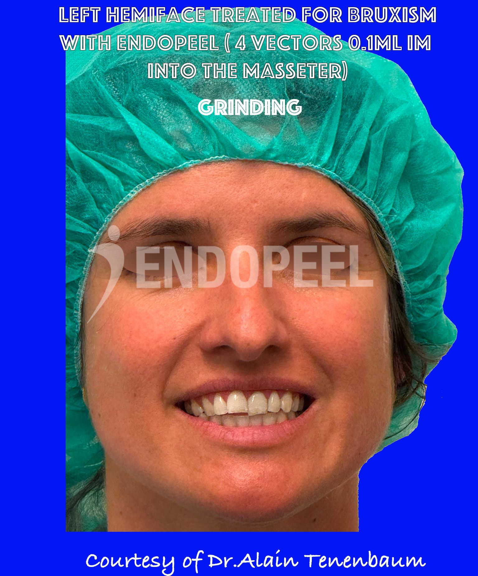 bruxism-grinding