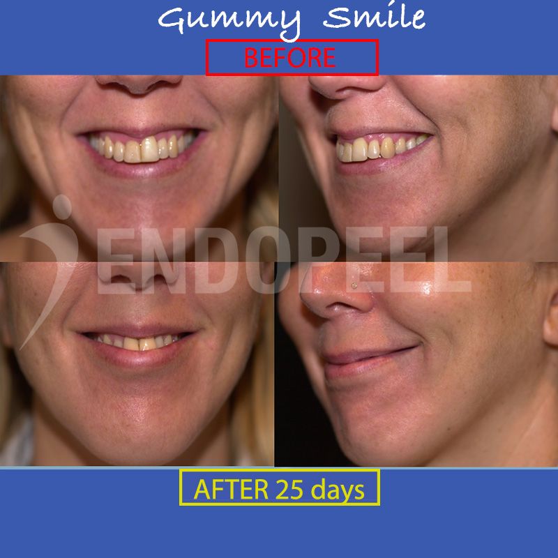 gummy-smile-d25