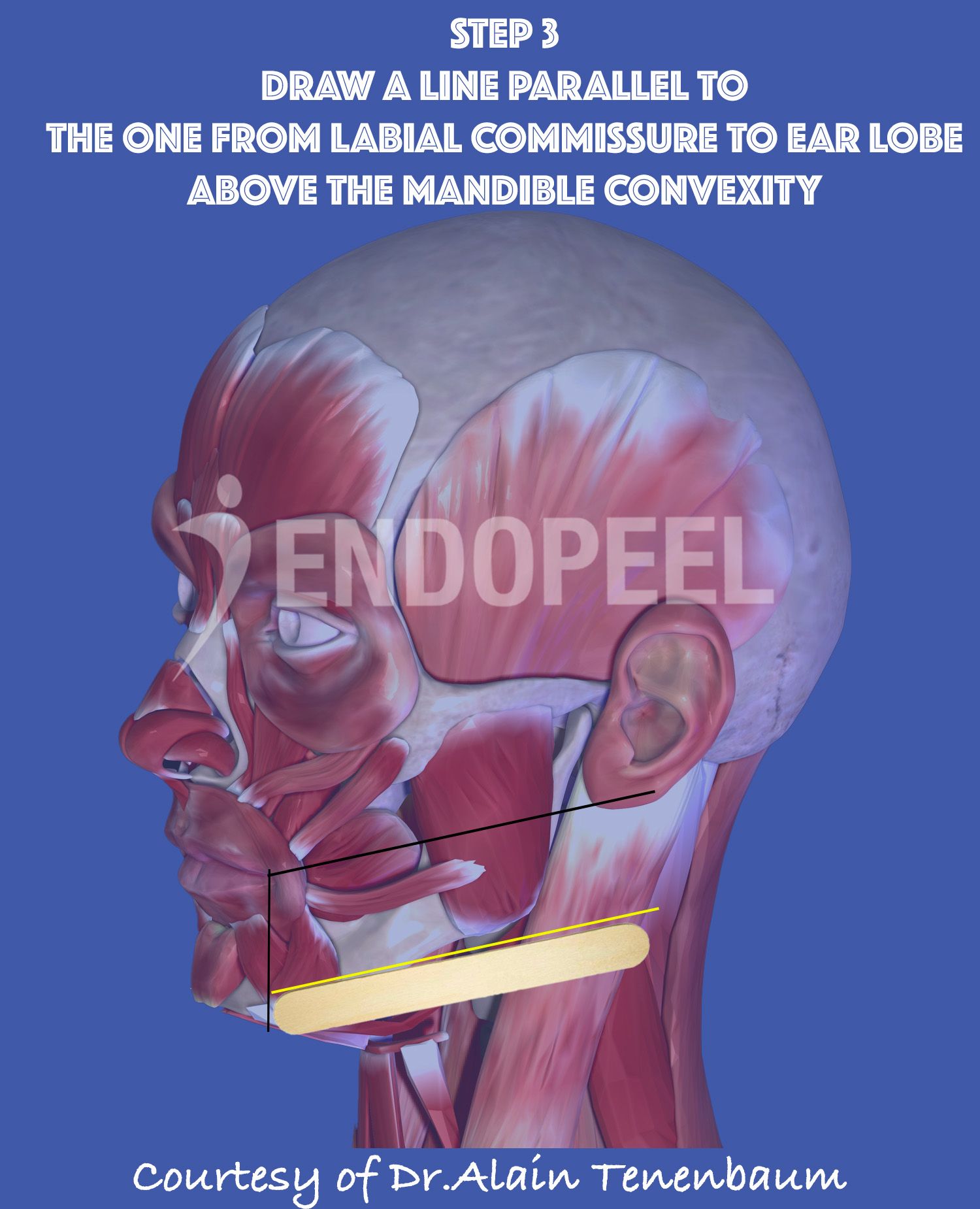 Step 3 :   line above the mandible convexity parallel to the 1 st line