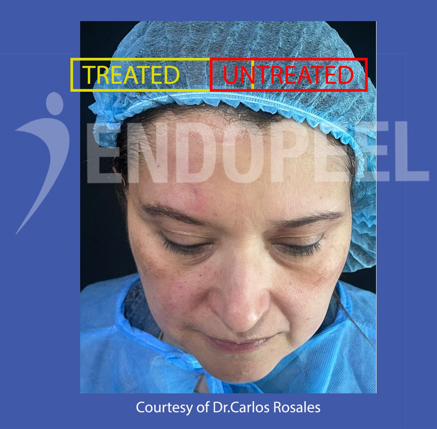 face basse endopeel dr carlos rosales 2023